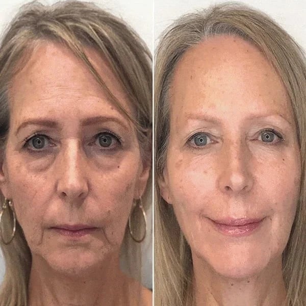 š„Botox Face Serum