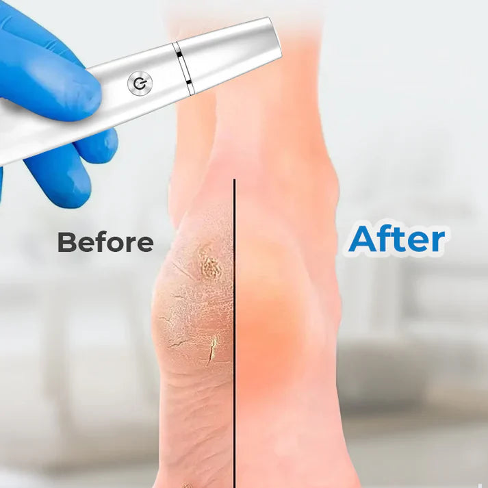 🔥Hot Sale - 50% OFF🔥Electric Feet Callus Remover⚡