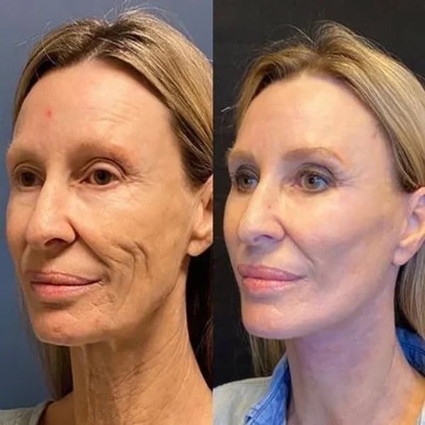 š„Botox Face Serum