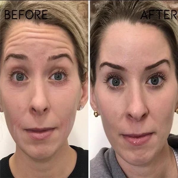š„Botox Face Serum