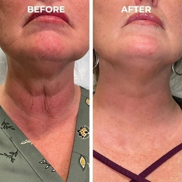 š„Botox Face Serum