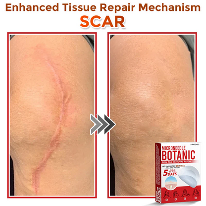 🌈 MicroNeedle Botanic Skin Tag Removal Patch 🇺🇸 Made in the USA