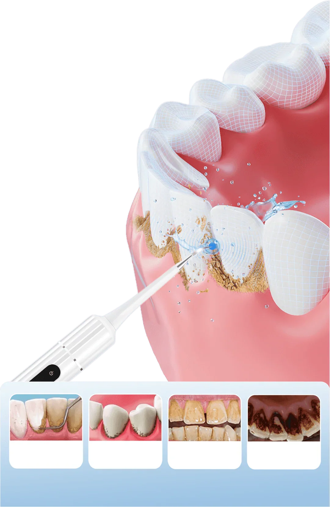 😁Ultrasonic Teeth Whitening Cleaner Set