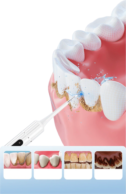 😁Ultrasonic Teeth Whitening Cleaner Set