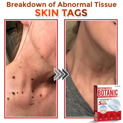 🌈 MicroNeedle Botanic Skin Tag Removal Patch 🇺🇸 Made in the USA