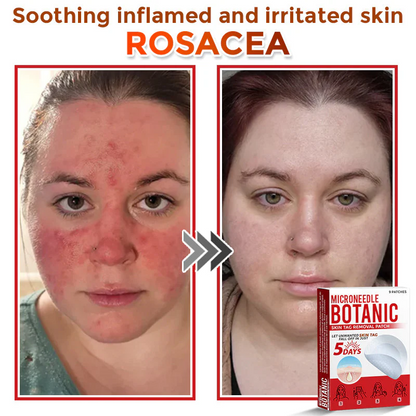 🌈 MicroNeedle Botanic Skin Tag Removal Patch 🇺🇸 Made in the USA