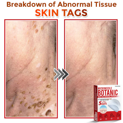 🌈 MicroNeedle Botanic Skin Tag Removal Patch 🇺🇸 Made in the USA