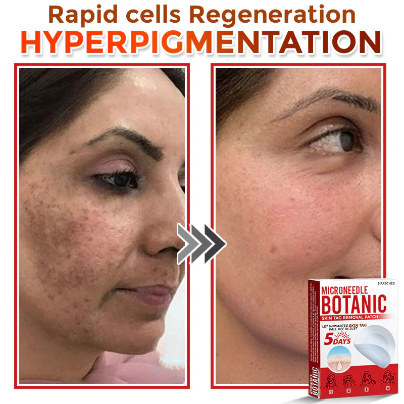 🌈 MicroNeedle Botanic Skin Tag Removal Patch 🇺🇸 Made in the USA